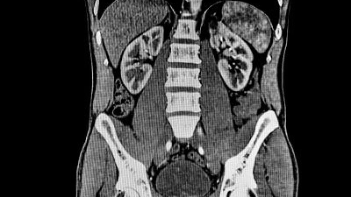 CT scan of the abdomen